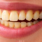 Why Are My Teeth Yellow When I Brush Them Every Day?